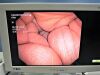 OLYMPUS BF-Q180AC Bronchoscope