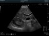 HITACHI C22P Ultrasound Transducer