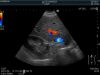HITACHI C22P Ultrasound Transducer