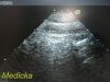 ACUSON 7V3C Phased Array Ultrasound Transducer Probe *TESTED* Ultrasound Transducer