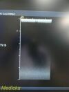 ACUSON 15L8 Ergo Linear Array (LA) Ultrasound Transducer