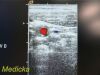 ACUSON 15L8 Ergo Linear Array (LA) Ultrasound Transducer