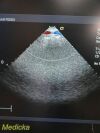 ACUSON 7V3C Phased Array Ultrasound Transducer