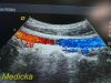ACUSON 8C4 Convex Array Ultrasound Transducer