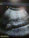ACUSON 8C4 Convex Array Ultrasound Transducer