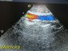 ACUSON 10V4 Vector Array Ultrasound Transducer