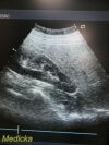 ACUSON 6C2 Convex Ultrasound Transducer