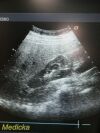 ACUSON 6C2 Convex Ultrasound Transducer