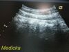 ACUSON 6C2 Convex Ultrasound Transducer