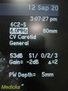 ACUSON 6C2 Model 0824B186 Convex Ultrasound Transducer