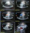 ACUSON 4V2 Vector Array Ultrasound Transducer
