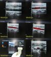 ACUSON 6L3 Linear Array Ultrasound Transducer