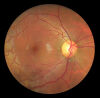 DEC 1000P Fundus Camera