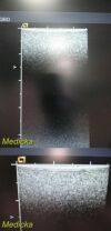 ACUSON 15L8 Ergo Linear Array Ultrasound Transducer