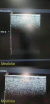 ACUSON 15L8 50mm, 8.0 Mhz Ergo Linear Array Ultrasound Transducer