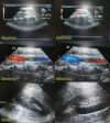 ACUSON 4V2 Sector Array Ultrasound Transducer