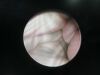 CODMAN 83-1520 0 degree neuroscope