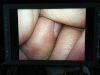 OLYMPUS LTF-V3 Laparoscope