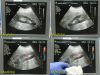 PHILIPS C5-2 40R Curved Array Ultrasound Transducer