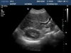 PHILIPS C5-2 Ultrasound Transducer