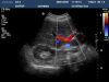 PHILIPS C5-2 Ultrasound Transducer