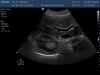 PHILIPS C6-3 Ultrasound Transducer