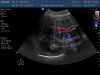 PHILIPS C6-3 Ultrasound Transducer