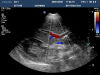 PHILIPS S4-1 Ultrasound Transducer
