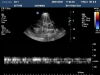 PHILIPS S4-1 Ultrasound Transducer
