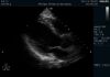 PHILIPS S4-2 Ultrasound Transducer