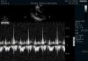 PHILIPS S4-2 Ultrasound Transducer