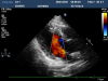 PHILIPS X3-1 Ultrasound Transducer