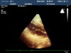 PHILIPS X3-1 Ultrasound Transducer