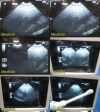 GE MTZ 6.5 Mhz Endocavity Ultrasound Transducer