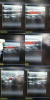 ACUSON 15L8W Linear Array Ultrasound Transducer