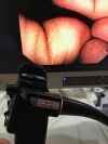 OLYMPUS JF Type 100 Duodenoscope