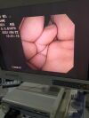OLYMPUS CYF-V2 with OTVs7 image processor . Cystoscope