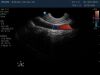 PHILIPS C9-5ec Ultrasound Transducer