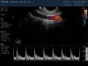 PHILIPS C9-5ec Ultrasound Transducer