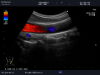 ALOKA UST-987 Ultrasound Transducer