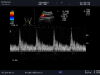 ALOKA UST-987 Ultrasound Transducer