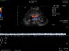 HITACHI C251 Ultrasound Transducer