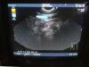 ALOKA UST-670P Ultrasound Transducer