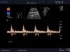 ALOKA UST-9104 Ultrasound Transducer