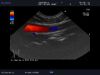 ALOKA UST-9136U Ultrasound Transducer