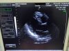 MEDISON P2-5AC Ultrasound Transducer
