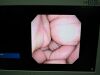 OLYMPUS LF-V Intubation Scope