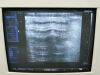 SIEMENS VF13-5 Ultrasound Transducer