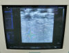 SIEMENS VFX 9-4 Ultrasound Transducer