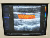SIEMENS VFX 9-4 Ultrasound Transducer